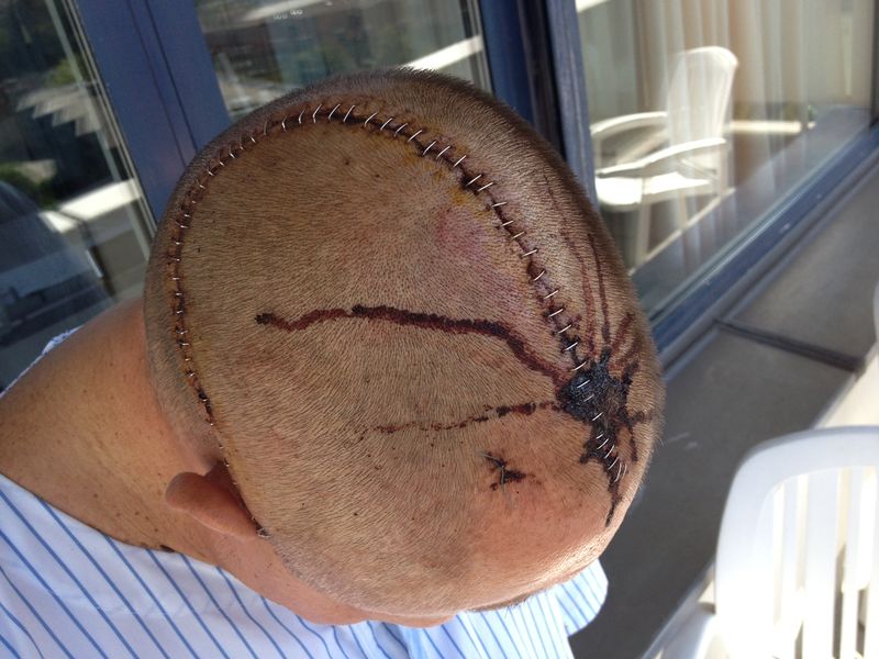 62 staples brain surgery.jpg. 62 staples brain surgery.jpg.